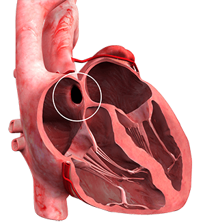 Septal Defect