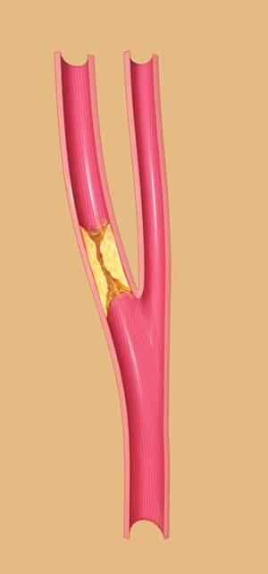 Carotid Artery Disease