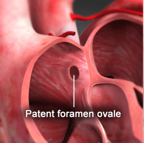 Congenital Heart Disease