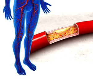 Peripheral Vascular Disease