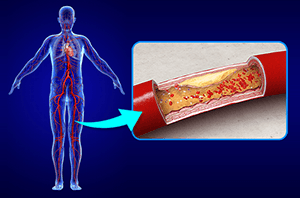 Peripheral Vascular Intervention