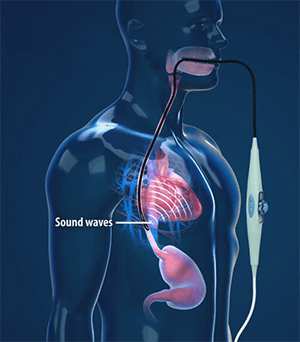 Transesophageal Echocardiography (TEE)