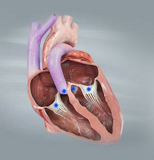 Valvular Heart Disease