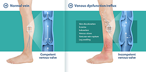 Varicose Vein Treatment - Center for Advanced Cardiac and Vascular