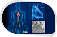 Cardiac Catheterization