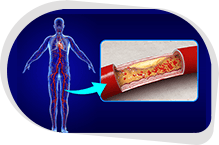 Peripheral Vascular Intervention